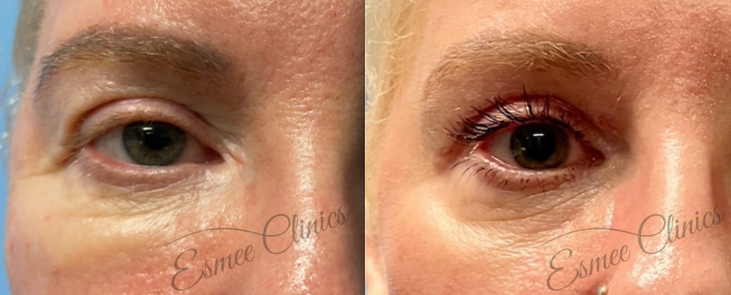 Before and After img